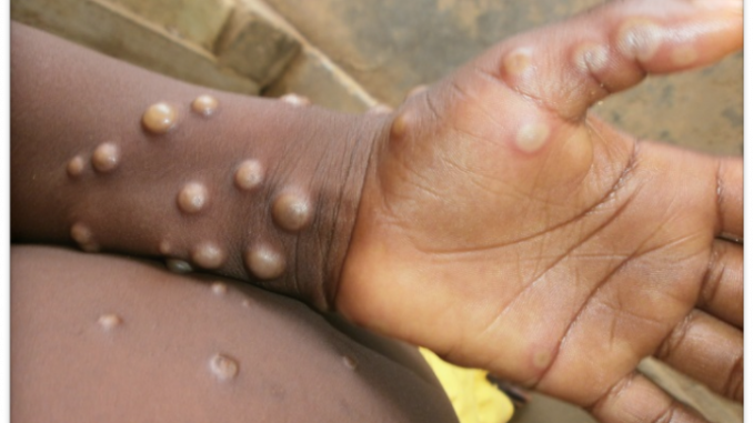 monkey pox image from who website