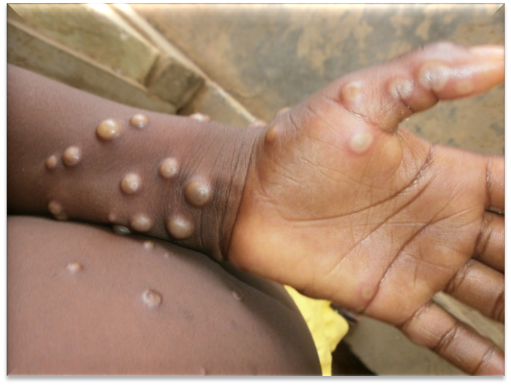 monkey pox image from who website